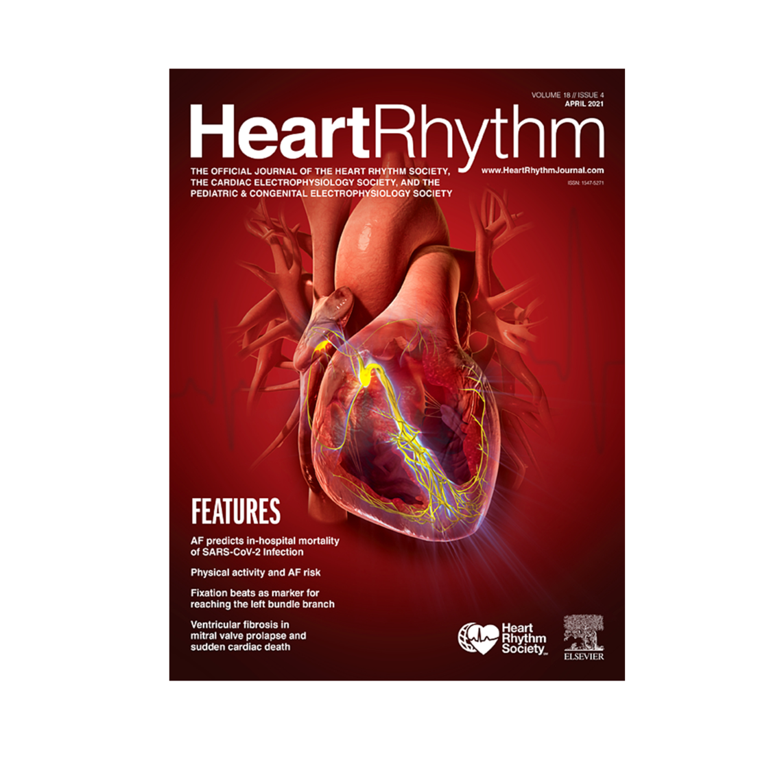 COVID-19 and cardiac arrhythmias